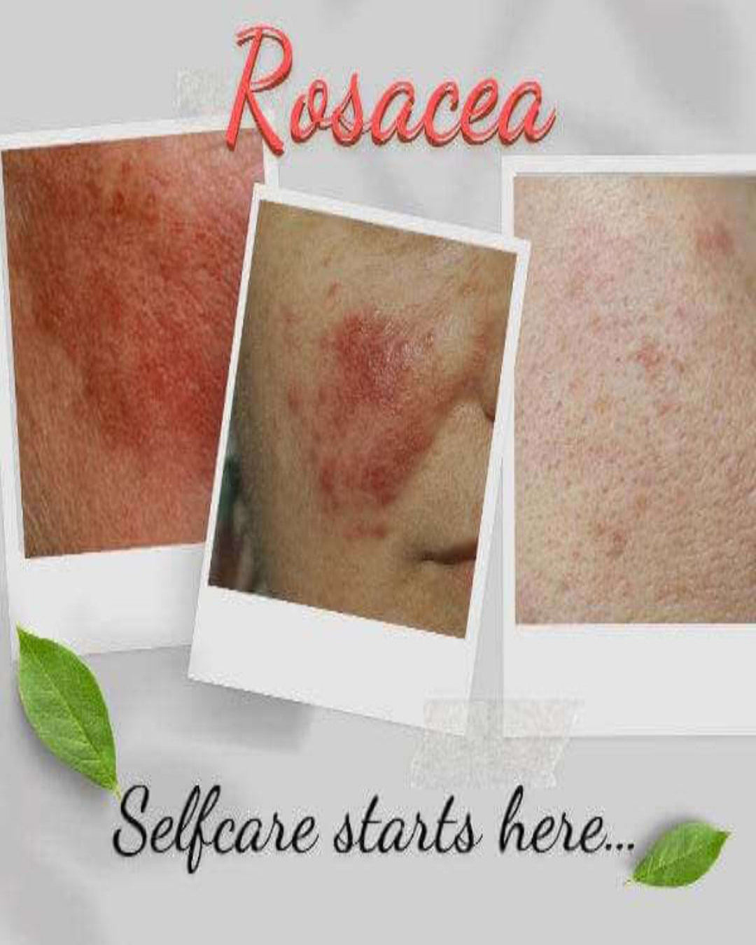 Organic Moisturizer for Rosacea Prone Skin - For Women and Men